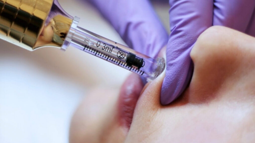 Filler labbra