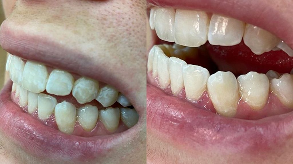 Macchie sui denti